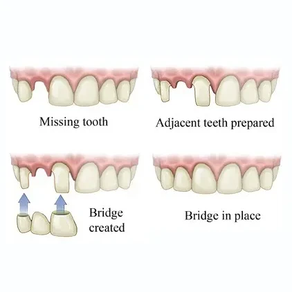graphic of dental bridges