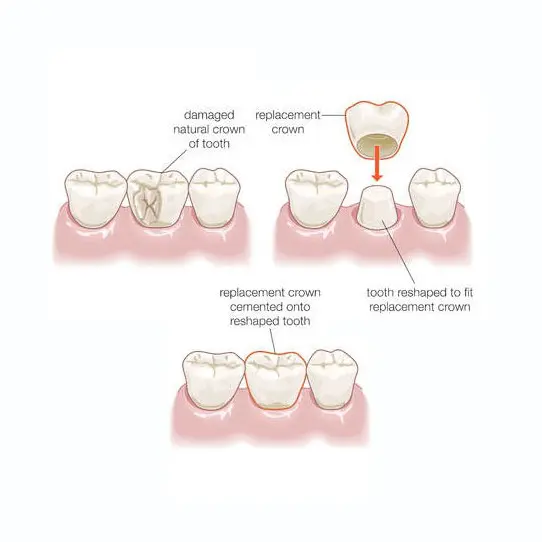 graphic of dental crowns