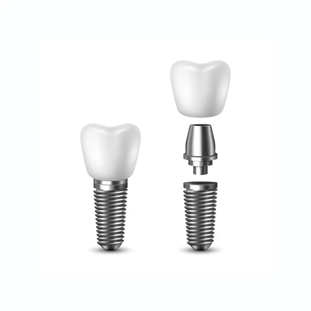 single-tooth implant | dental implants park city ut